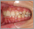 埋伏歯【永久歯列期】の症例3