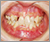 埋伏歯【永久歯列期】の症例5