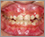 埋伏歯【混合歯列期】の症例5