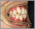 下顎前突症【受け口・永久歯列期】の症例6