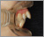 上顎前突症【出っ歯・永久歯列期】の症例22