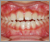 開咬症【混合歯列期】の症例3