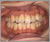 癒合歯の症例1